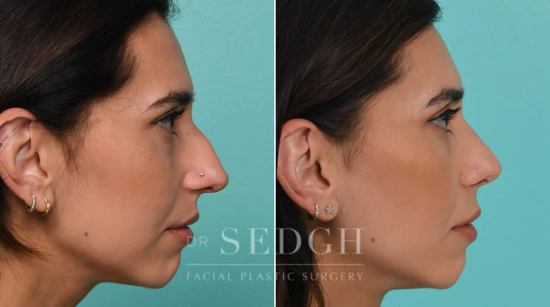 rhinoplasty surgery cost