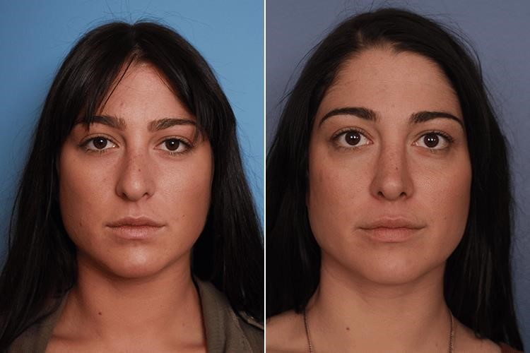 rhinoplasty surgery cost