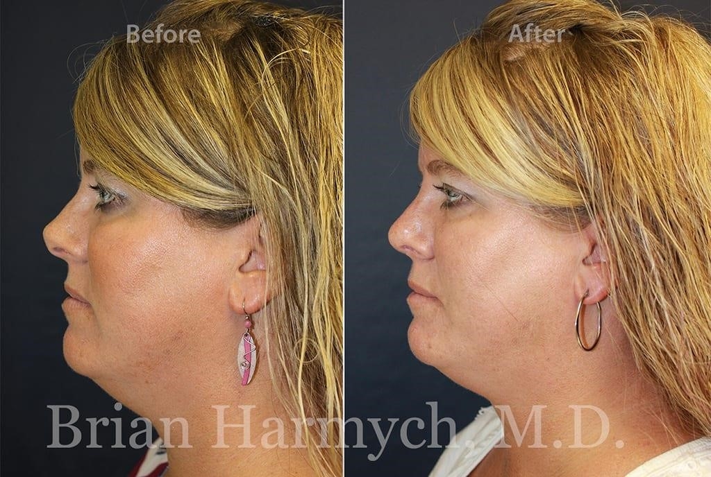 rhinoplasty surgery cost